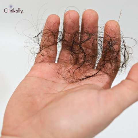 Exploring the Link Between Saw Palmetto and Hair Loss Myth or Reality