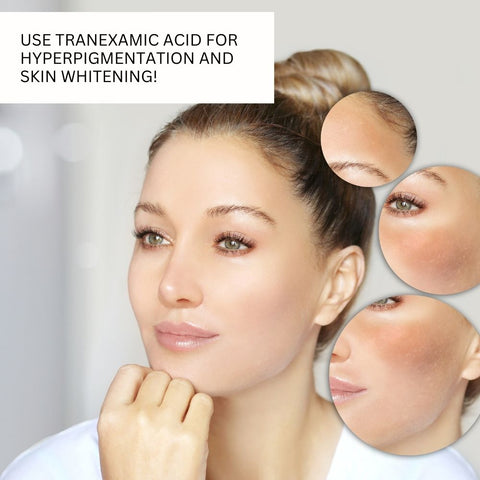 Use Tranexamic Acid for Hyperpigmentation and Skin Whitening!
