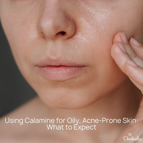 Using Calamine for Oily, Acne-Prone Skin: What to Expect