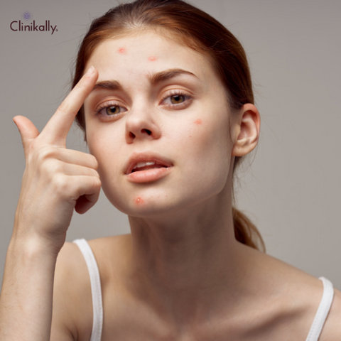 Differin Gel Acne Treatment: How to Use & More