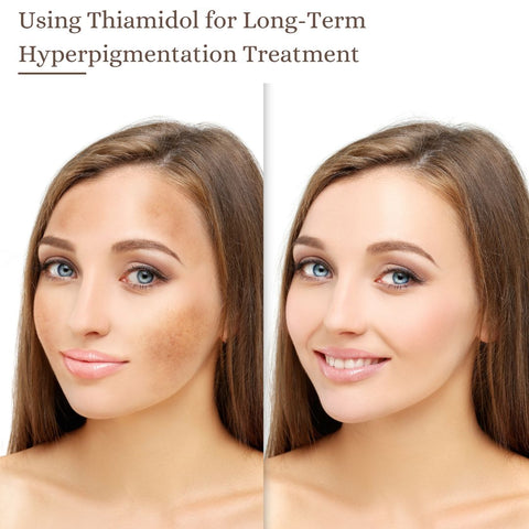 Using Thiamidol for Long-Term Hyperpigmentation Treatment