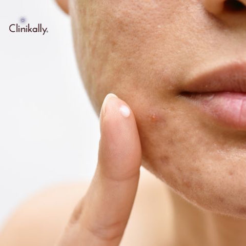 Doxycycline for Acne: A Comprehensive Guide