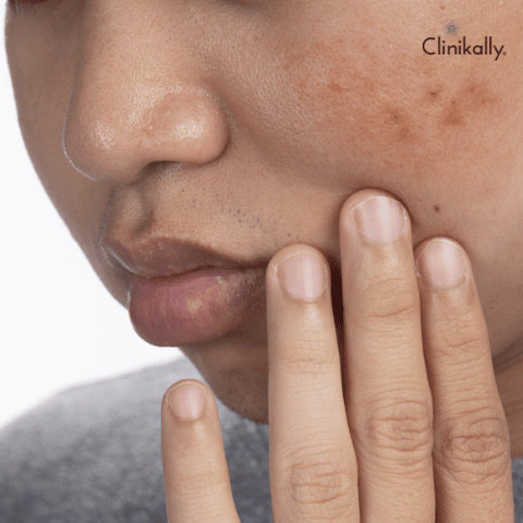 Reduce brown spots