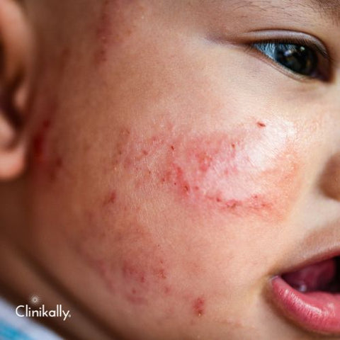Managing Atopic Dermatitis: Tips for Effective Recovery