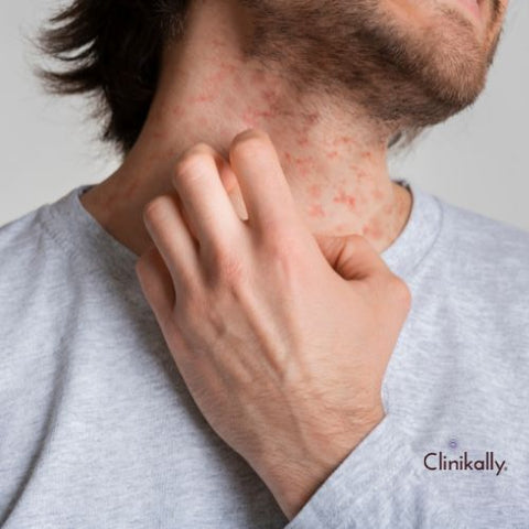 Managing Atopic Dermatitis: Tips for Effective Recovery