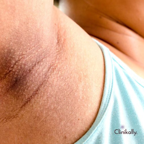 Getting Rid of Dark Armpits for Smooth, Even Skin