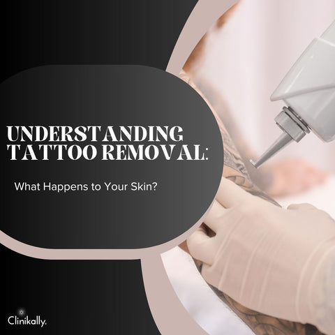 Understanding Tattoo Removal: What Happens to Your Skin?