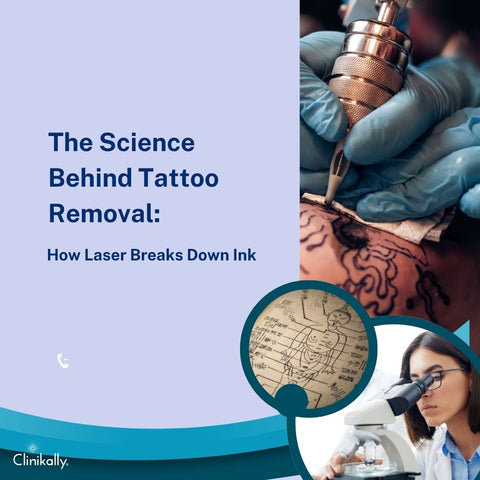 The Science Behind Tattoo Removal: How Laser Breaks Down Ink