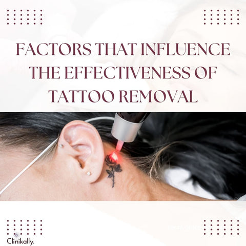 Factors That Influence the Effectiveness of Tattoo Removal
