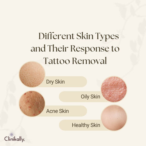 Different Skin Types and Their Response to Tattoo Removal