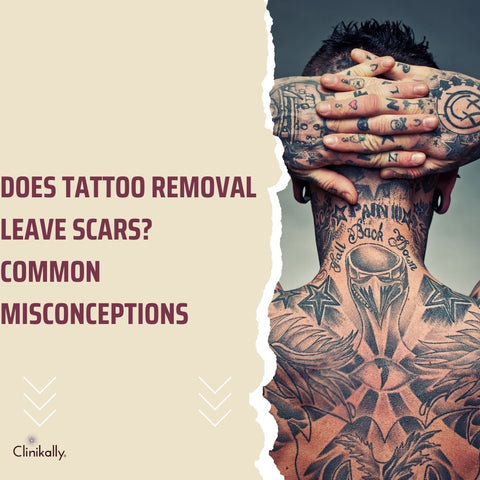 Does Tattoo Removal Leave Scars? Common Misconceptions