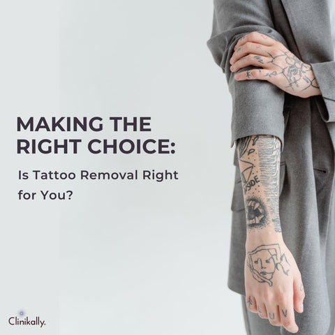 Making the Right Choice: Is Tattoo Removal Right for You?