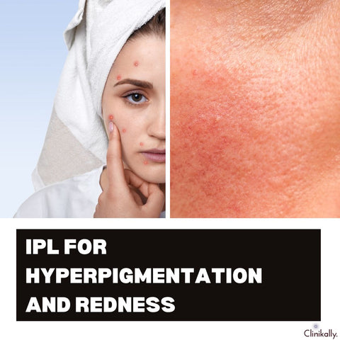 IPL for Hyperpigmentation and Redness