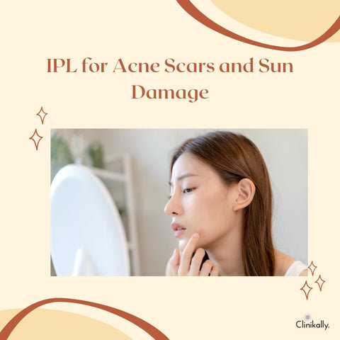 IPL for Acne Scars and Sun Damage