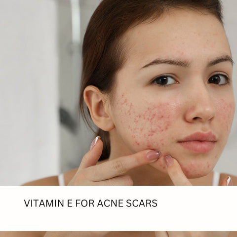 Vitamin E for Acne Scars