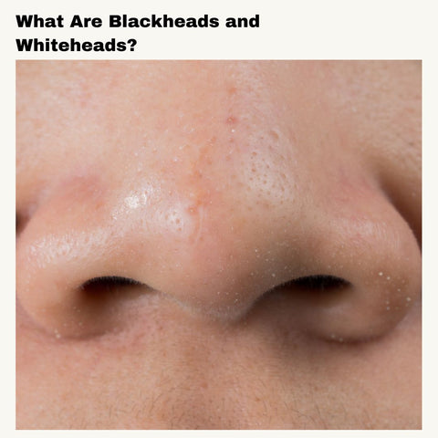 What Are Blackheads and Whiteheads?