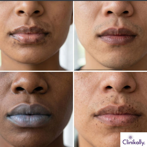 How To Get Rid of Dark Lips: Causes & Treatment