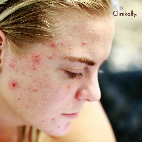 Acne Purge vs Breakout