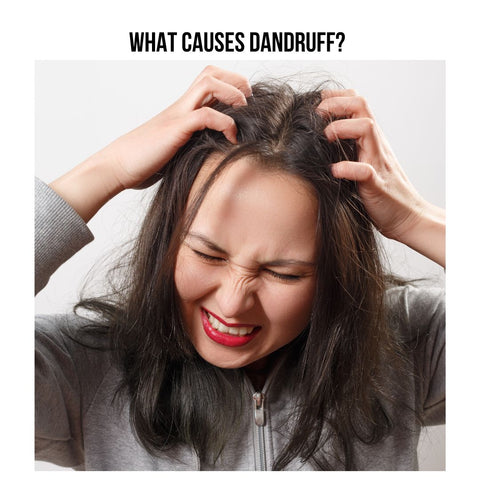 What Causes Dandruff?