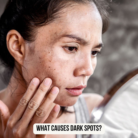 What Causes Dark Spots?