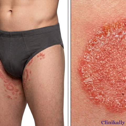 Fungal rash in the groin area with red scaly patches