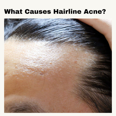 What Causes Hairline Acne?