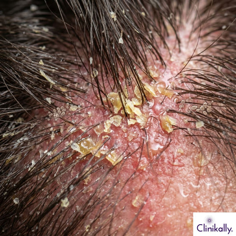 Close-up of scalp biofilm buildup