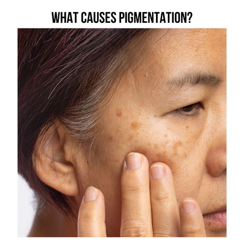 What Causes Pigmentation?