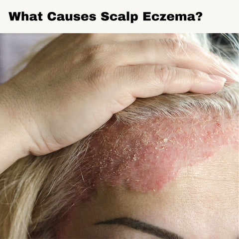 What Causes Scalp Eczema?