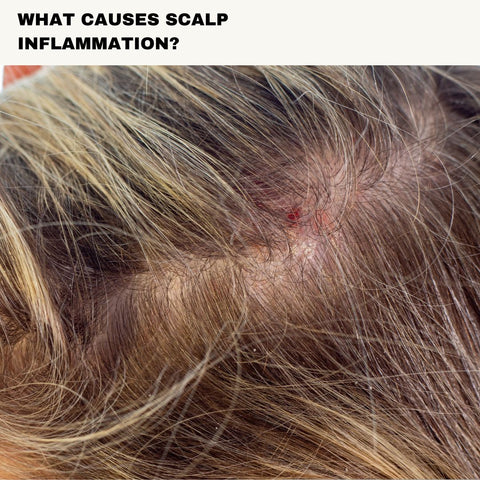 A women with her scalp imflamed "What Causes Scalp Inflammation?"