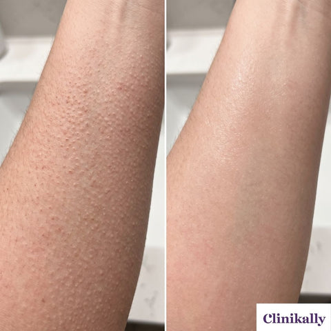 Keratosis pilaris before and after