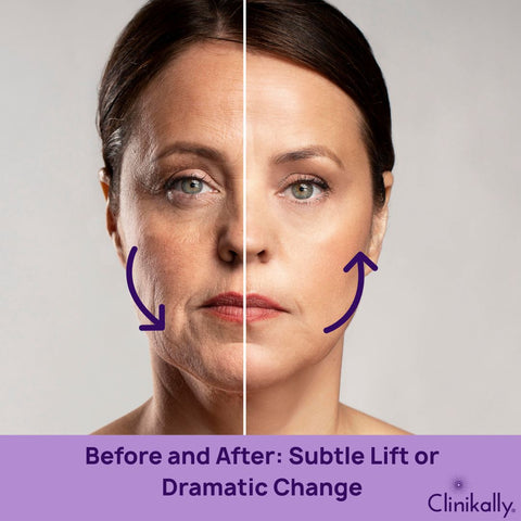 Before and After: Subtle Lift or Dramatic Change?