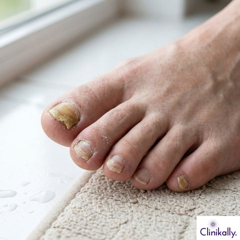 Thick yellow toenails caused by nail fungus