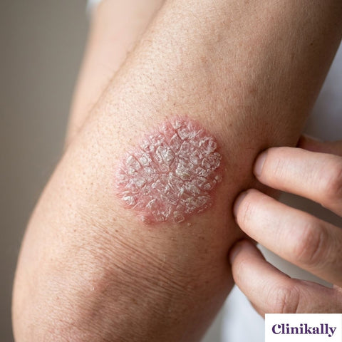 Close-up of a scaly psoriasis patch on the elbow