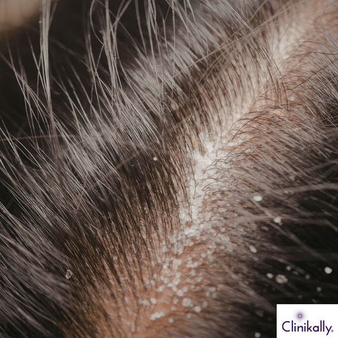 Scalp dandruff and flaky skin
