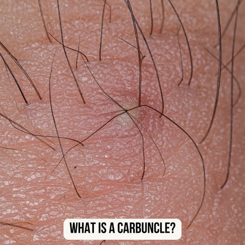 What Is a Carbuncle?