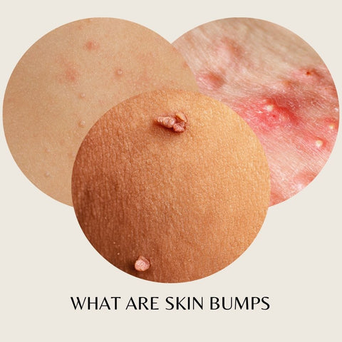 What are Skin Bumps