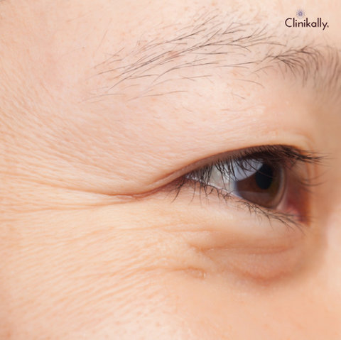 dehydration lines and wrinkles 