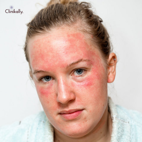 arnica for skin