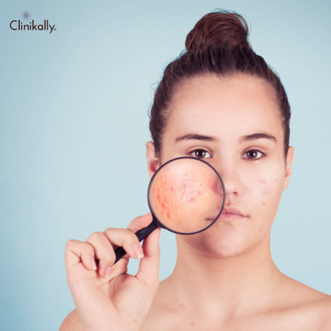 The Truth About Junk Food and Acne: Separating Fact from Fiction