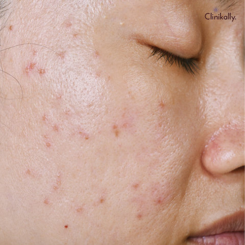 kojic acid for skin