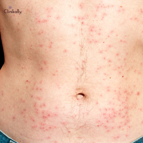 keratosis pilaris treatment