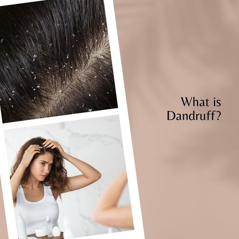 What is Dandruff?