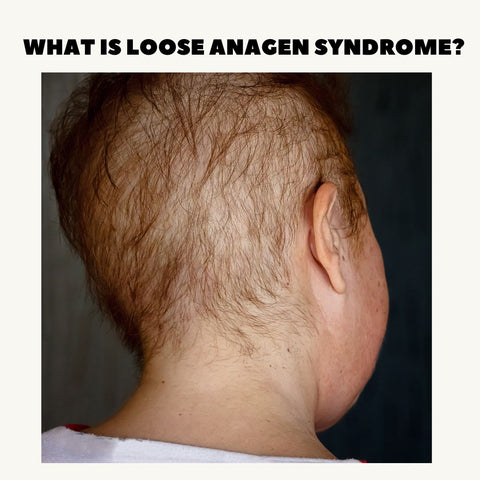 What is Loose Anagen Syndrome?