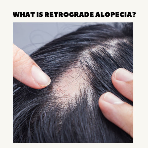 What is Retrograde Alopecia?