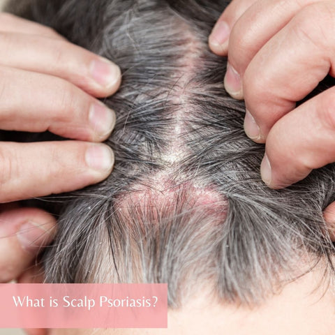 What is Scalp Psoriasis?