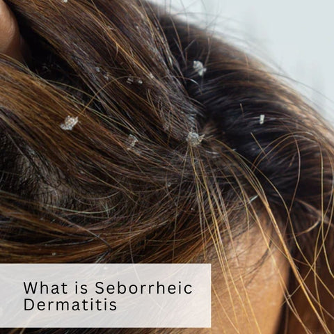 What is Seborrheic Dermatitis