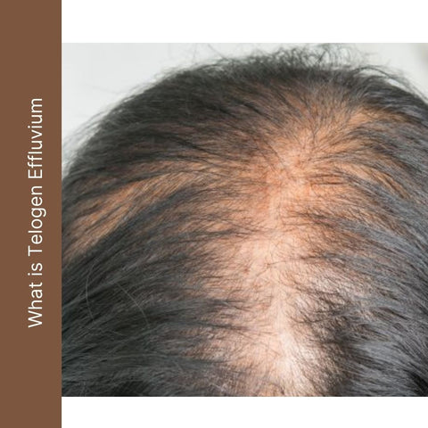 What is Telogen Effluvium