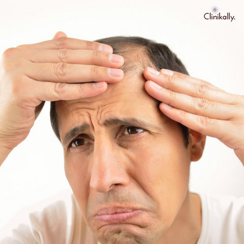 What Happens After You Stop Minoxidil Use?