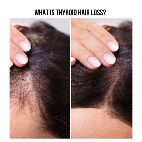What is Thyroid Hair Loss?